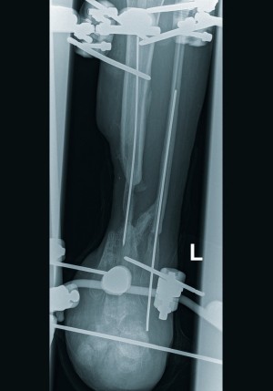 Abb. 1 a: Linker Unterschenkel in zwei Ebenen bei Aufnahme acht Monate nach Trauma. cme_schuss_abb_1a.jpg