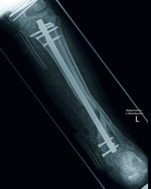 Abb. 4: Osteosynthetische Ausversorgung linker Unterschenkel, ca. 15 Monate nach Trauma. cme_schuss_abb_4.jpg