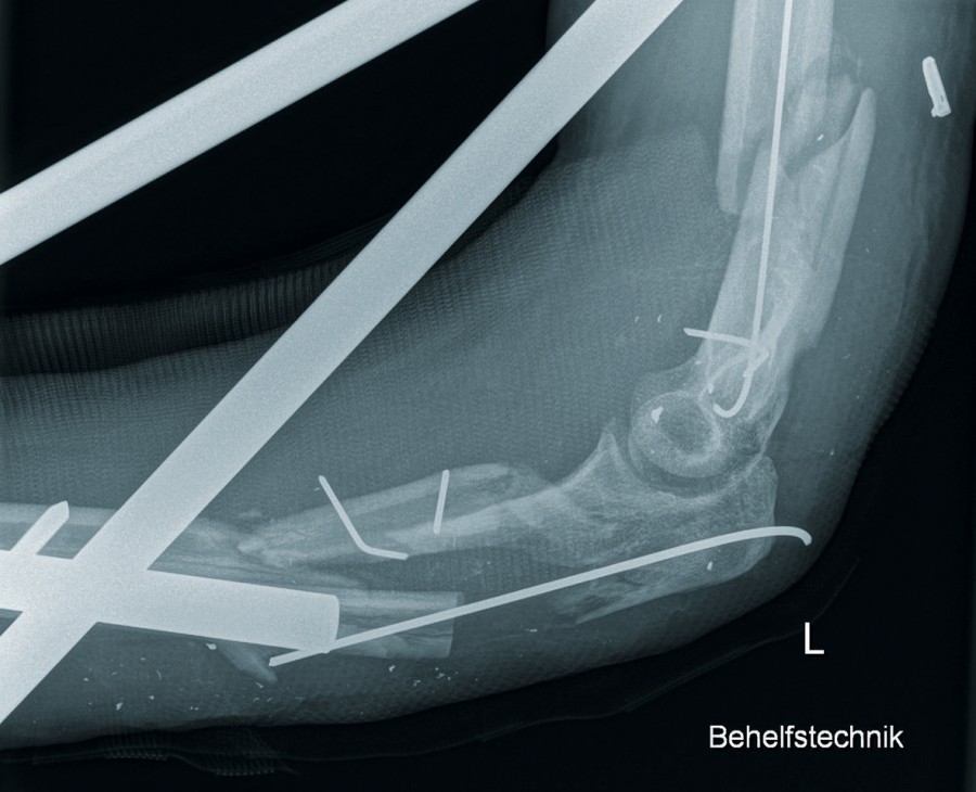 Abb. 5: Ossärer Ausgangsbefund linker Ellenbogen bei Aufnahme vier Wochen nach Trauma cme_schuss_abb_5_16052019.jpg