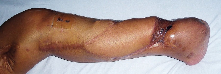 Abb. 3b: Vier Wochen postoperativ cme_schussverletzungenabb_3b_23022021_2.jpg