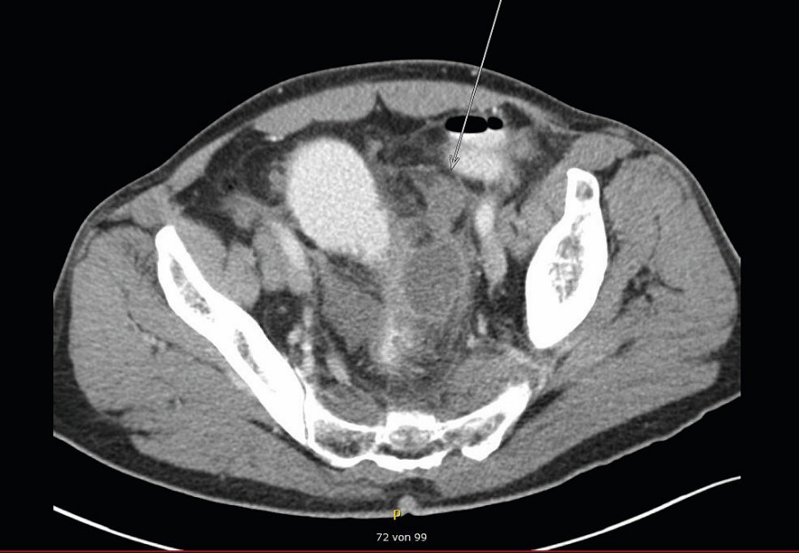 Abb. 1: CT Abdomen vom 24.05.2016 mit Nachweis der Tumormasse im Becken. kasuistik_bild_1_rexhaj_24052016.jpg