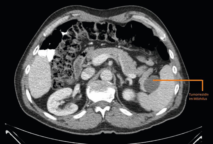 Abb. 2: CT Abdomen vom 23.09.2019 mit Darstellung des solitären Tumorrezidivs im Milzhilus. kasuistik_bild_2_rexhaj_23092019.jpg