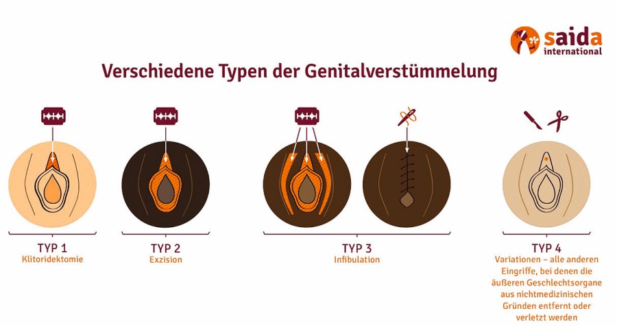 Es gibt insgesamt vier verschiedene FGM-Typen. abb1_fgm_typen_saida_ev.jpg