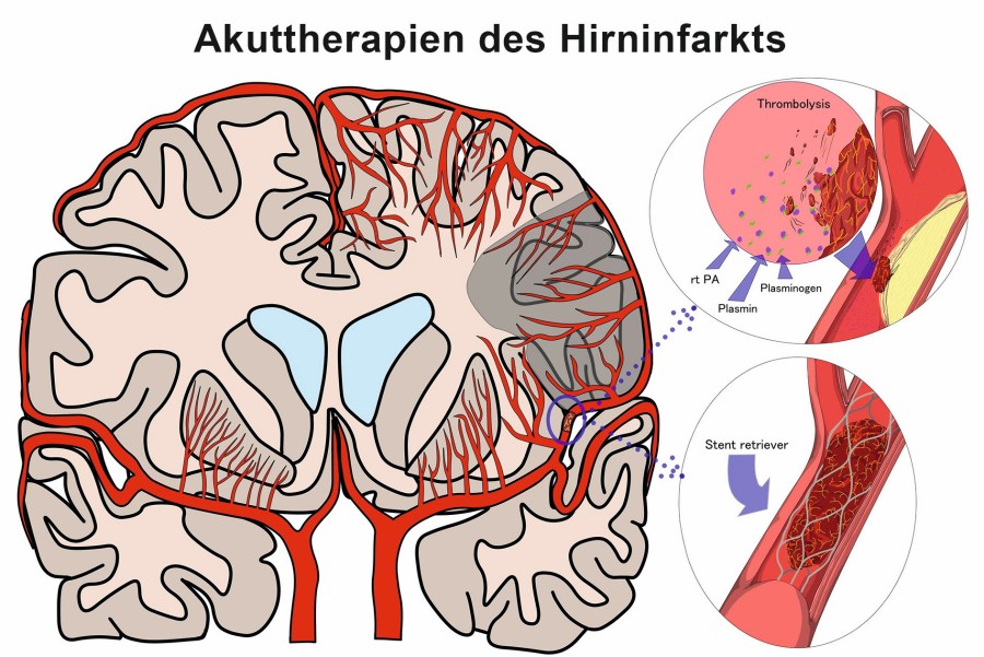 Akuttherapien des Hirninfarkts adobestock_357428141.jpg