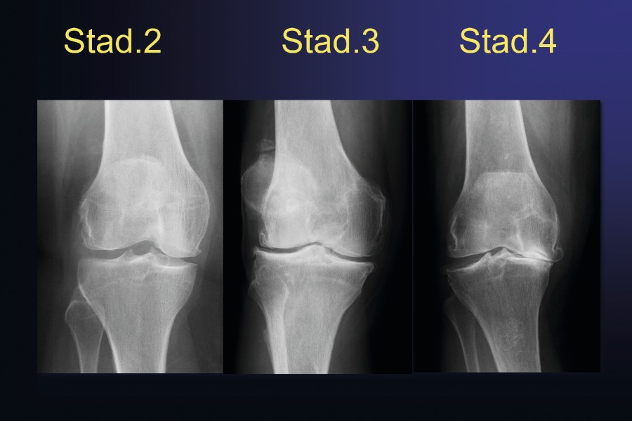 arthrose_abb_1.jpg arthrose_abb_1.jpg